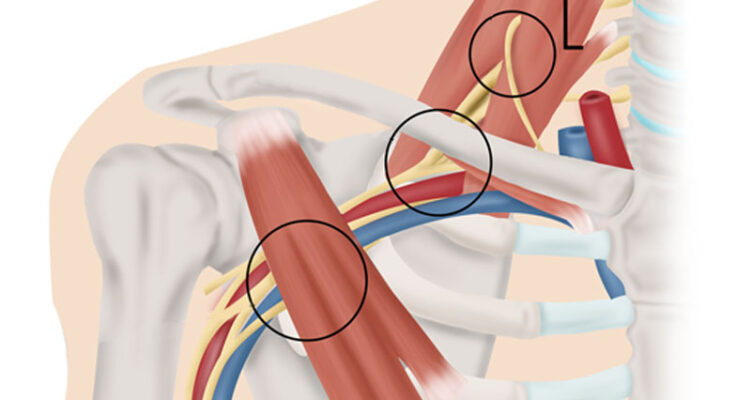 thoracic-outlet-syndrome